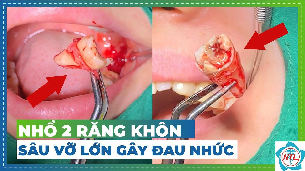 nhổ răng mọc lệch hàm trên - Image 3
