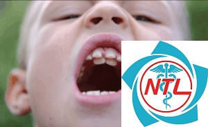 nhổ răng mọc lệch hàm trên