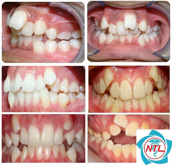 nhổ răng mọc lệch hàm trên - Image 5