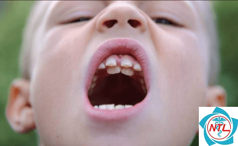nhổ răng mọc lệch hàm trên