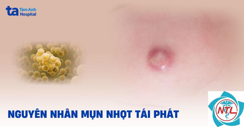 nhọt da tái phát - Image 4