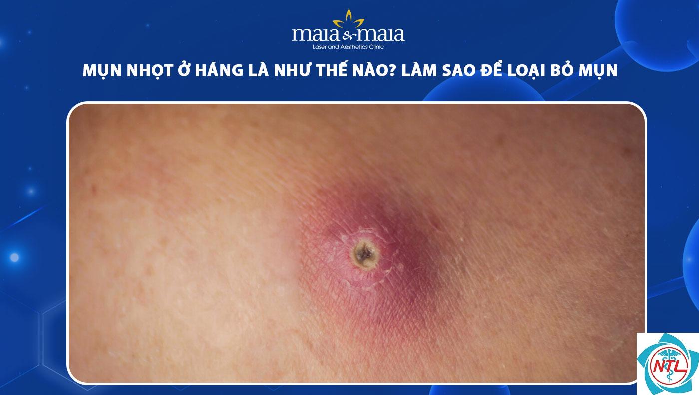 nhọt ở bẹn - Image 2