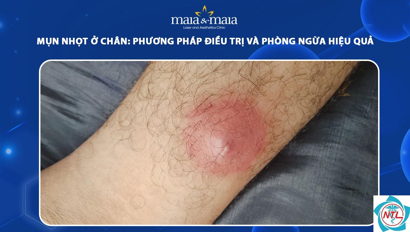 nhọt ở chân - Image 2