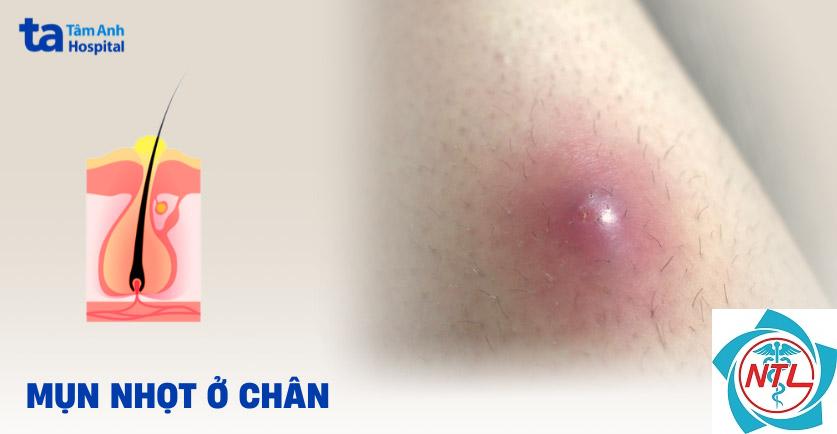 nhọt ở chân - Image 5
