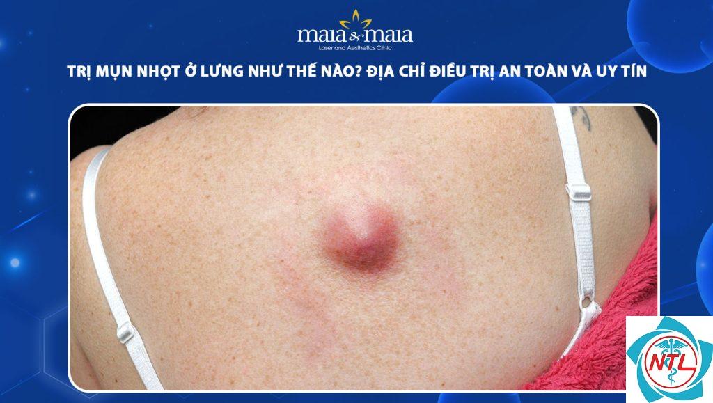nhọt ở lưng