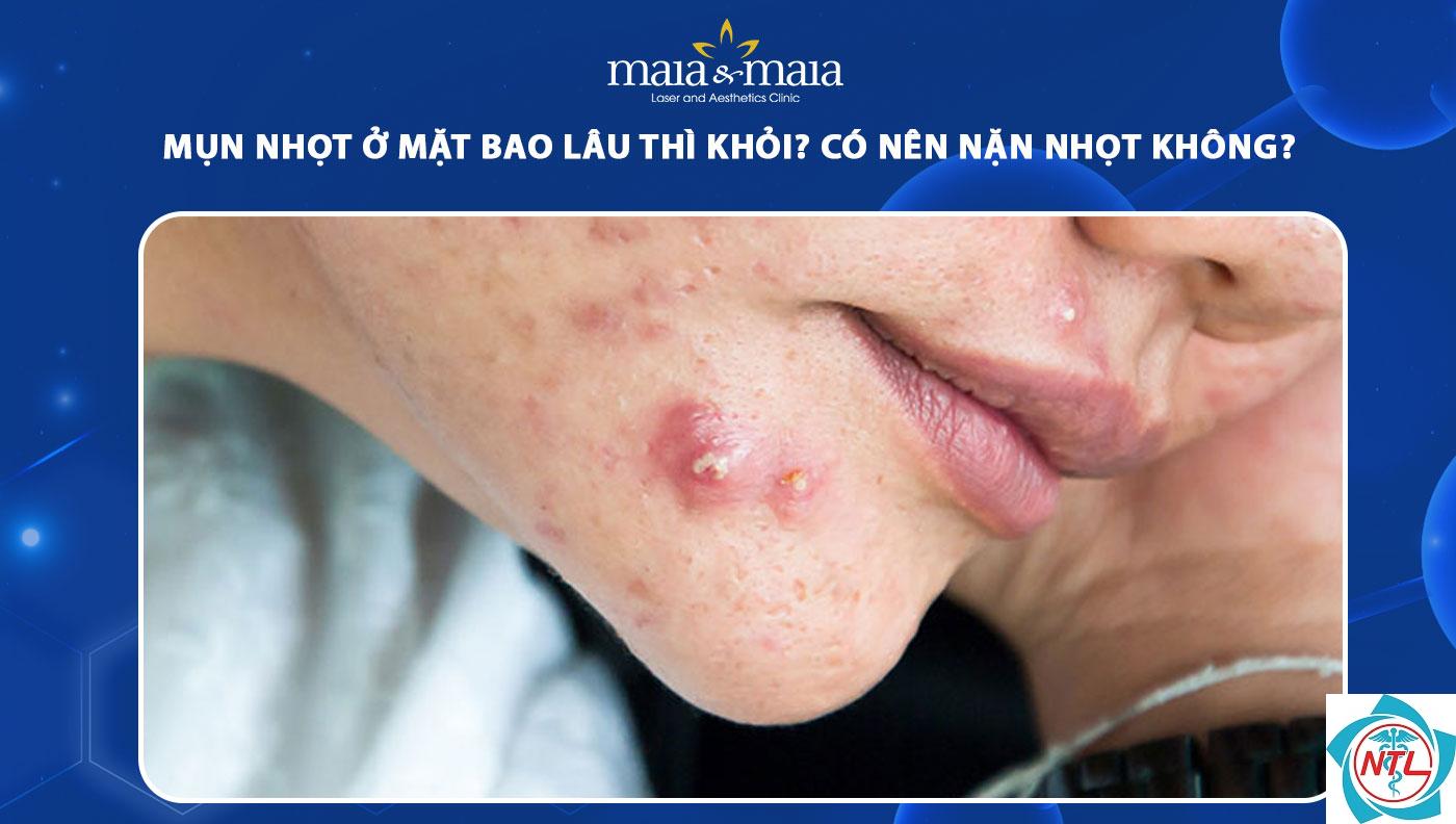 nhọt ở mặt - Image 3