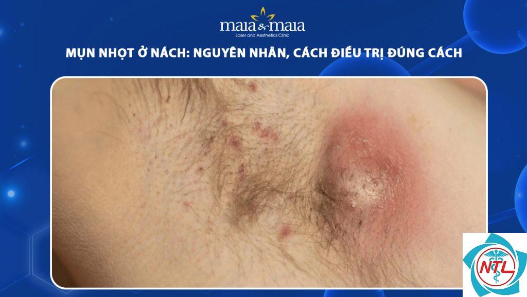 nhọt ở nách