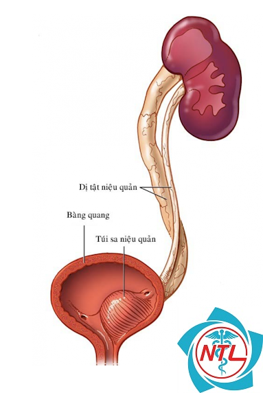 niệu quản đôi - Image 2