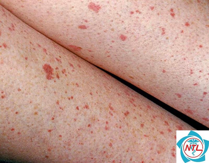 nốt xuất huyết trên da