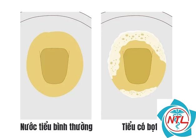 nước tiểu có bọt - Image 2