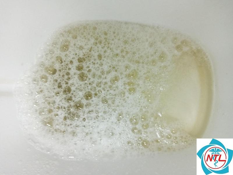 nước tiểu có bọt