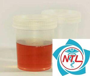 nước tiểu có máu