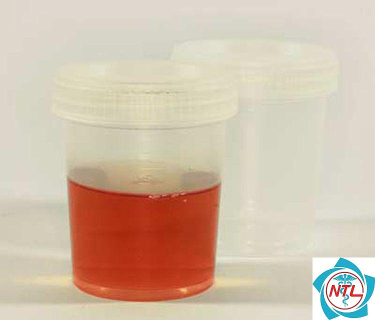 nước tiểu có máu