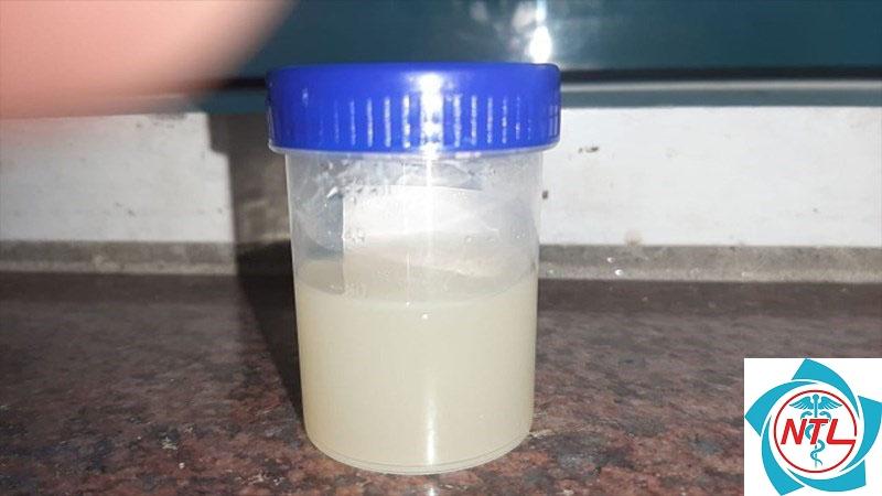 nước tiểu đục - Image 2