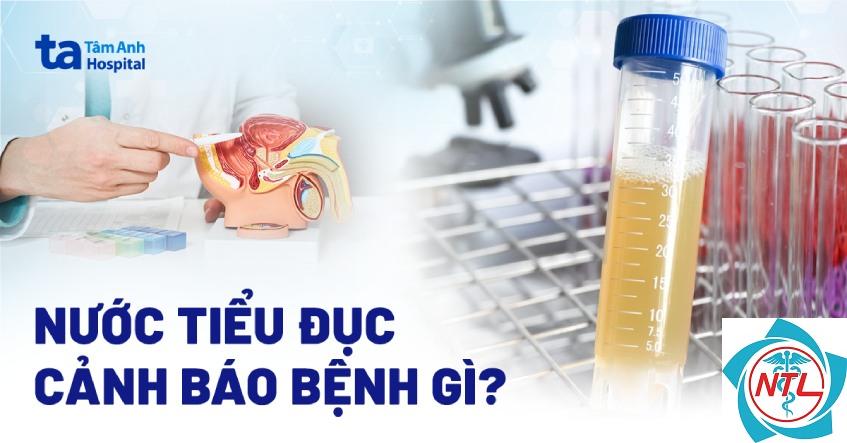 nước tiểu đục - Image 3
