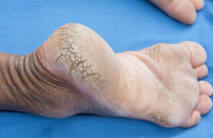 nứt gót chân và cách điều trị - Image 2