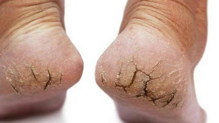 nứt gót chân và cách điều trị - Image 3