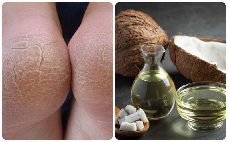 nứt gót chân và cách điều trị - Image 5