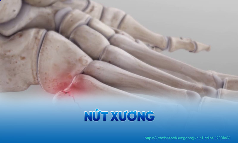 nứt xương - Image 2