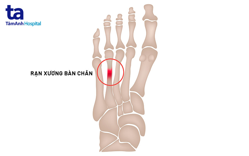 nứt xương - Image 3