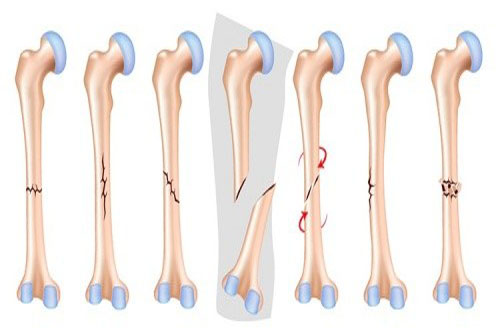 nứt xương - Image 4