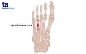 nứt xương bàn chân