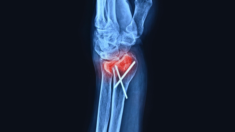 nứt xương có cần bó bột không - Image 2