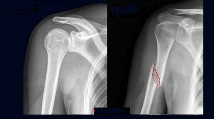 nứt xương có cần bó bột không