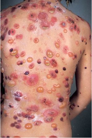 pemphigoid bóng nước - Image 2