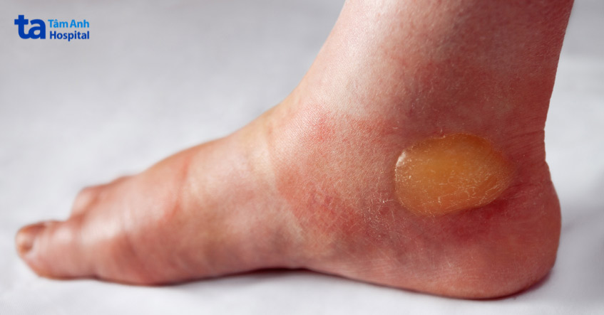 pemphigoid bóng nước - Image 3