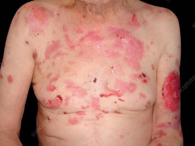 pemphigoid bóng nước - Image 4