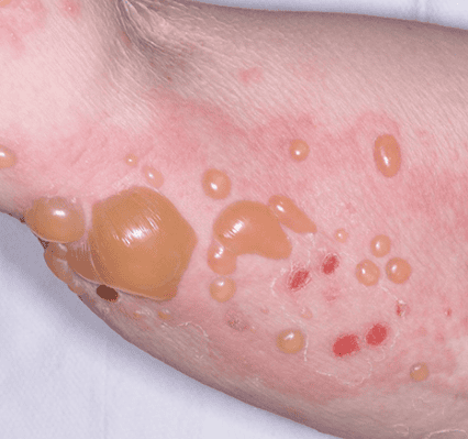 pemphigoid bóng nước