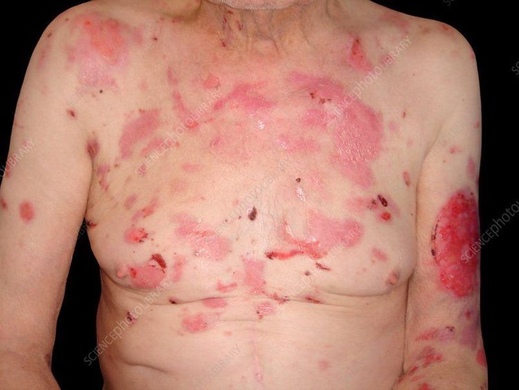 pemphigus - Image 2