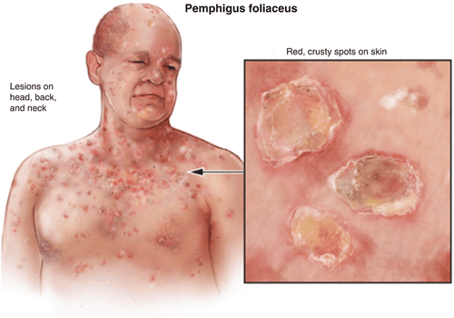 pemphigus - Image 3