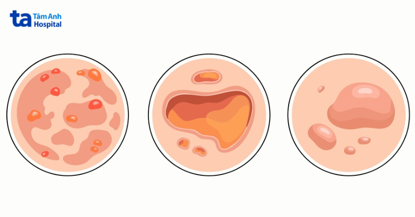 pemphigus - Image 4
