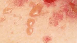 pemphigus - Image 5