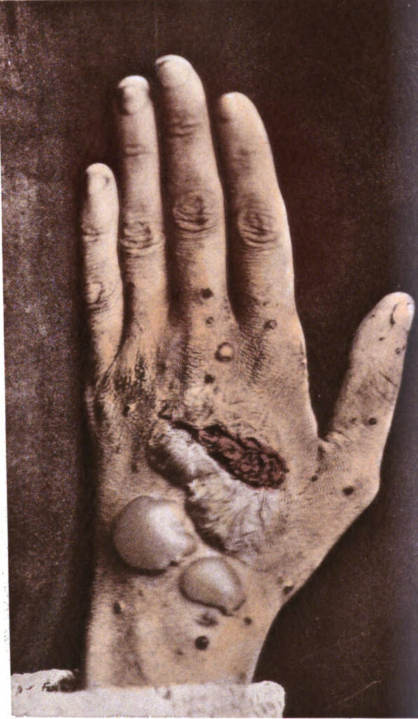 pemphigus