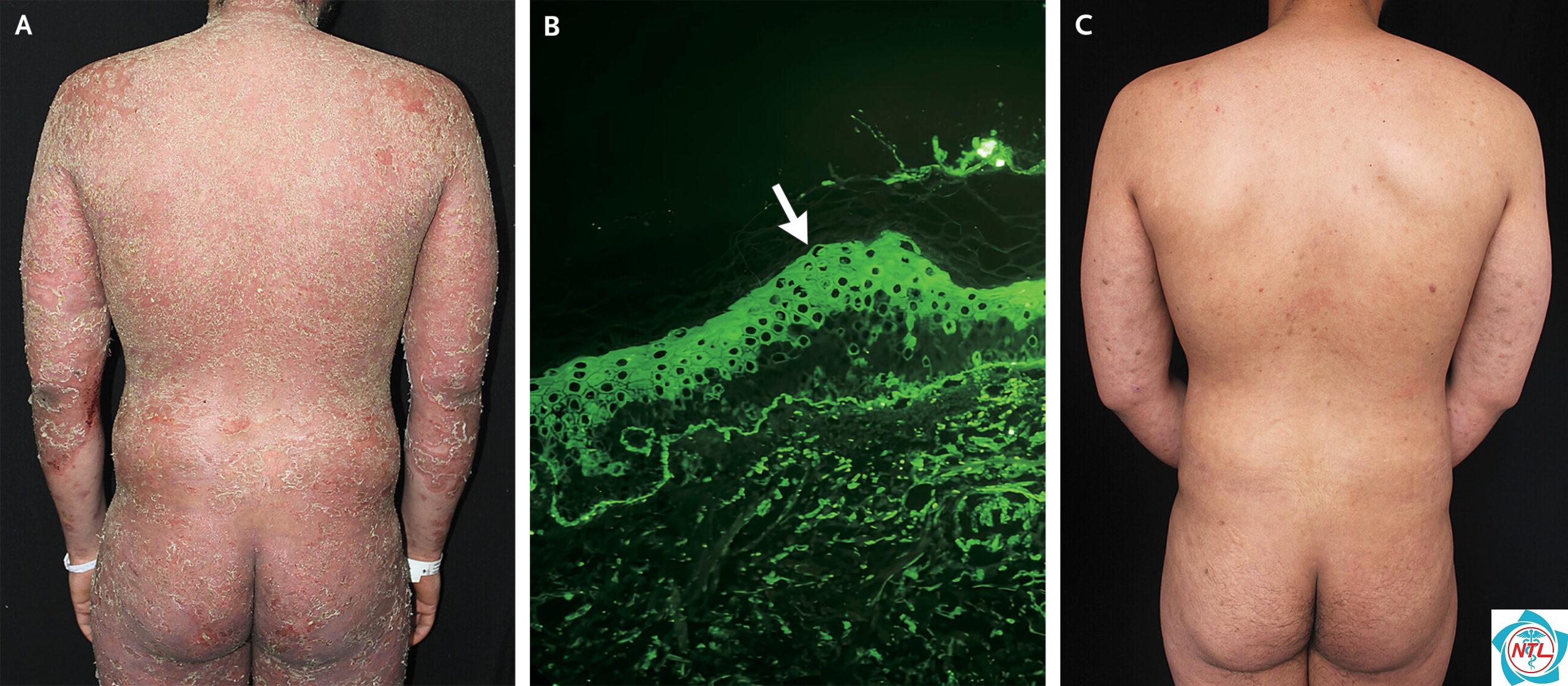 pemphigus foliaceus - Image 2