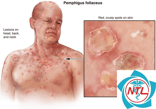 pemphigus foliaceus - Image 3