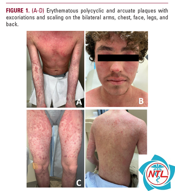 pemphigus foliaceus - Image 4