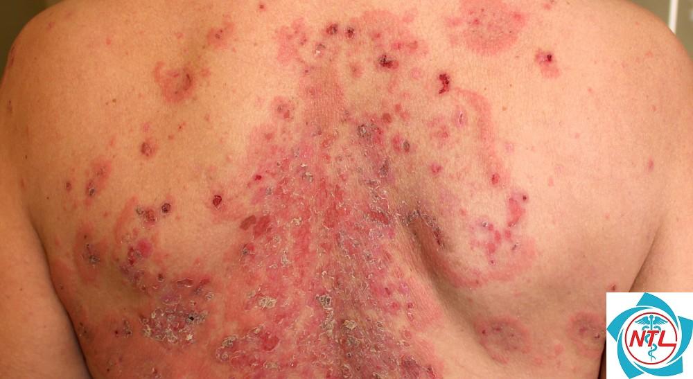 pemphigus foliaceus