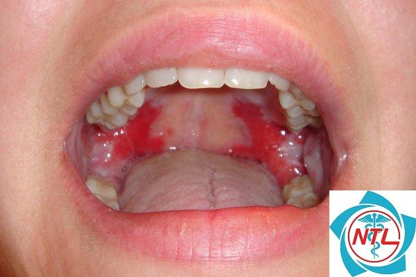 pemphigus vulgaris - Image 2
