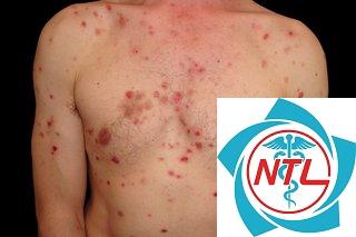 pemphigus vulgaris - Image 3