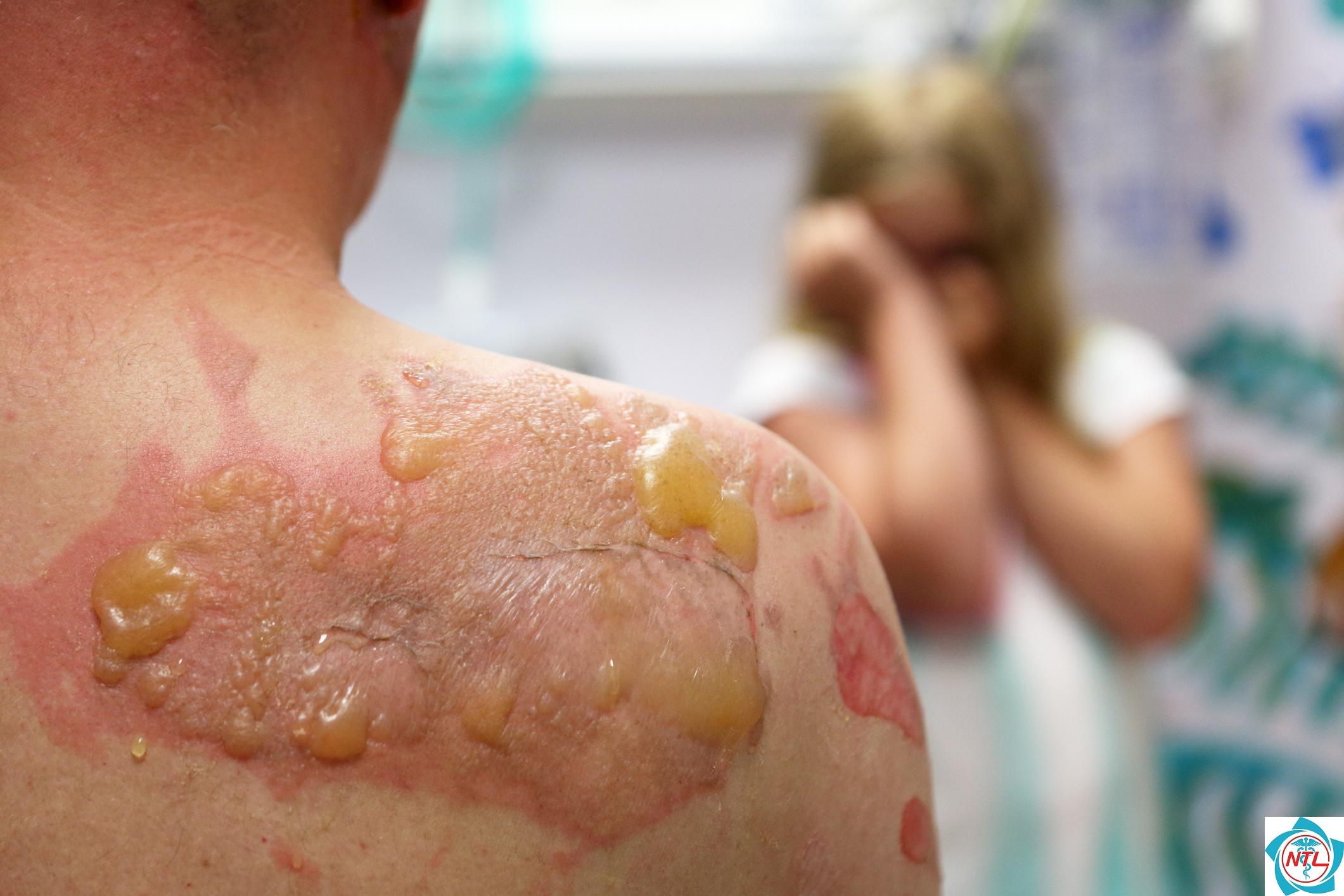 pemphigus vulgaris - Image 4