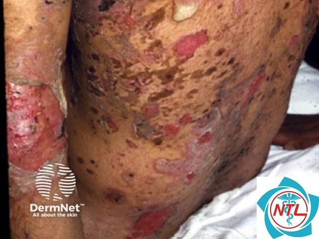 pemphigus vulgaris - Image 5