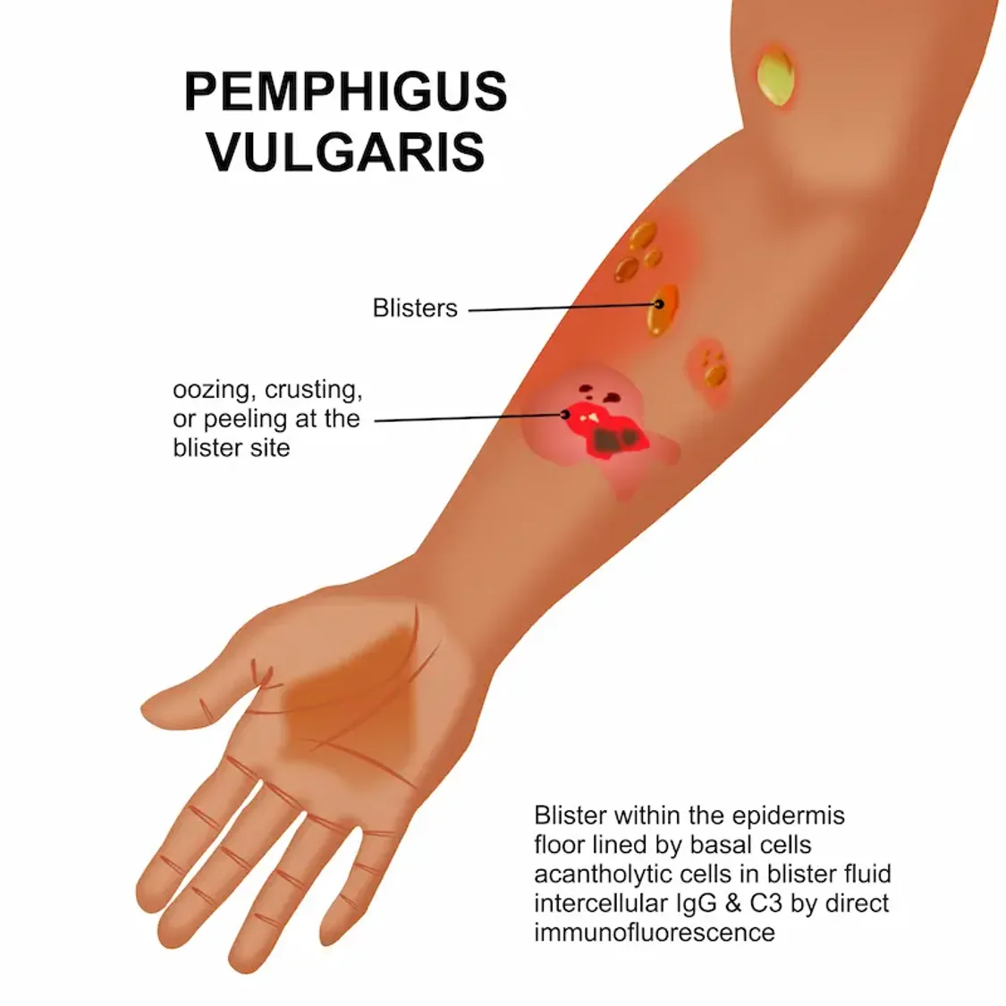 pemphigus vulgaris - Image 1