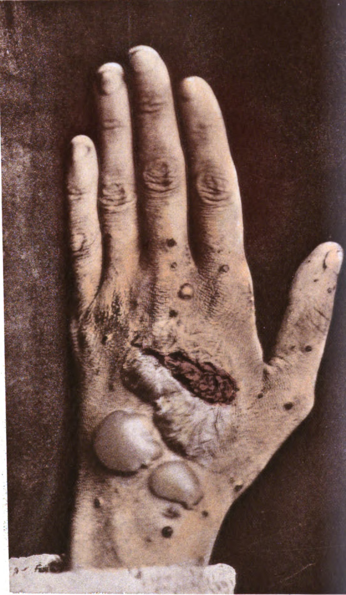 pemphigus - Image 1