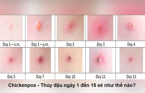 phát ban do thủy đậu - Image 3