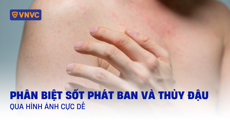 phát ban do thủy đậu - Image 1