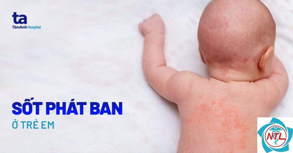 phát ban ở trẻ em